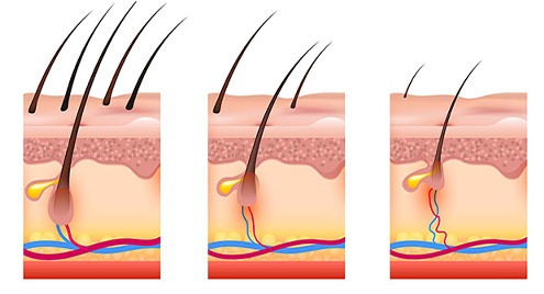 قرص سیپروترون استات برای مو